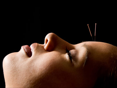 Acupuncture - Facial rejuvenation
